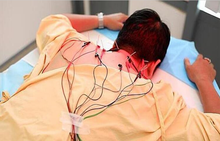 Điện mãng châm điều trị hội chứng cổ vai cánh tay (Chứng tý)